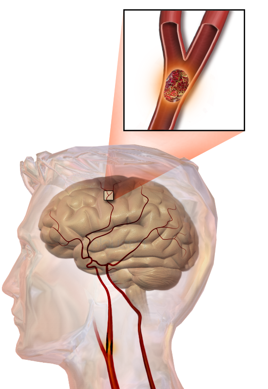 Stroke & Neurovascular Diseases